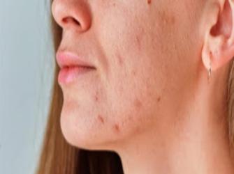 Problemas de pele podem ser de origem hormonal