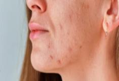 Problemas de pele podem ser de origem hormonal