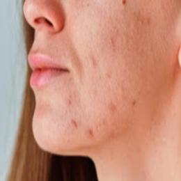 Problemas de pele podem ser de origem hormonal