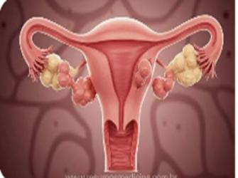 Mioma - tumor benigno composto de músculo uterino