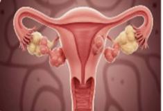 Mioma - tumor benigno composto de músculo uterino