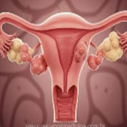 Mioma - tumor benigno composto de músculo uterino
