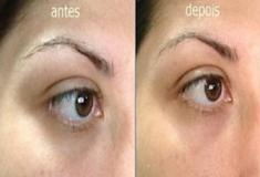 Você tem olheiras? Quer acabar com elas?