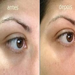 Você tem olheiras? Quer acabar com elas?