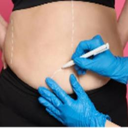Cirurgia bariátrica deve ser o último recurso contra a obesidade